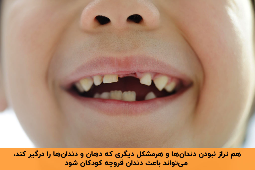 هم تراز نبودن دندان ها علت دندان قروچه کودکان